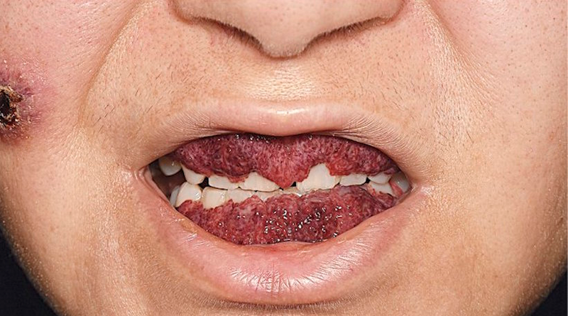 Illustration for article titled La peligrosa afección de la gingivitis de fresa: cuando las encías están tan inflamadas que parecen a punto de explotar